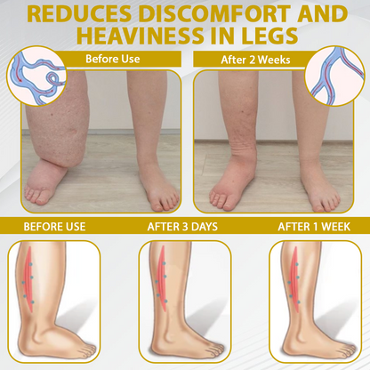 ATTDX® ApisChestnut Herbal Edema Relief Cream