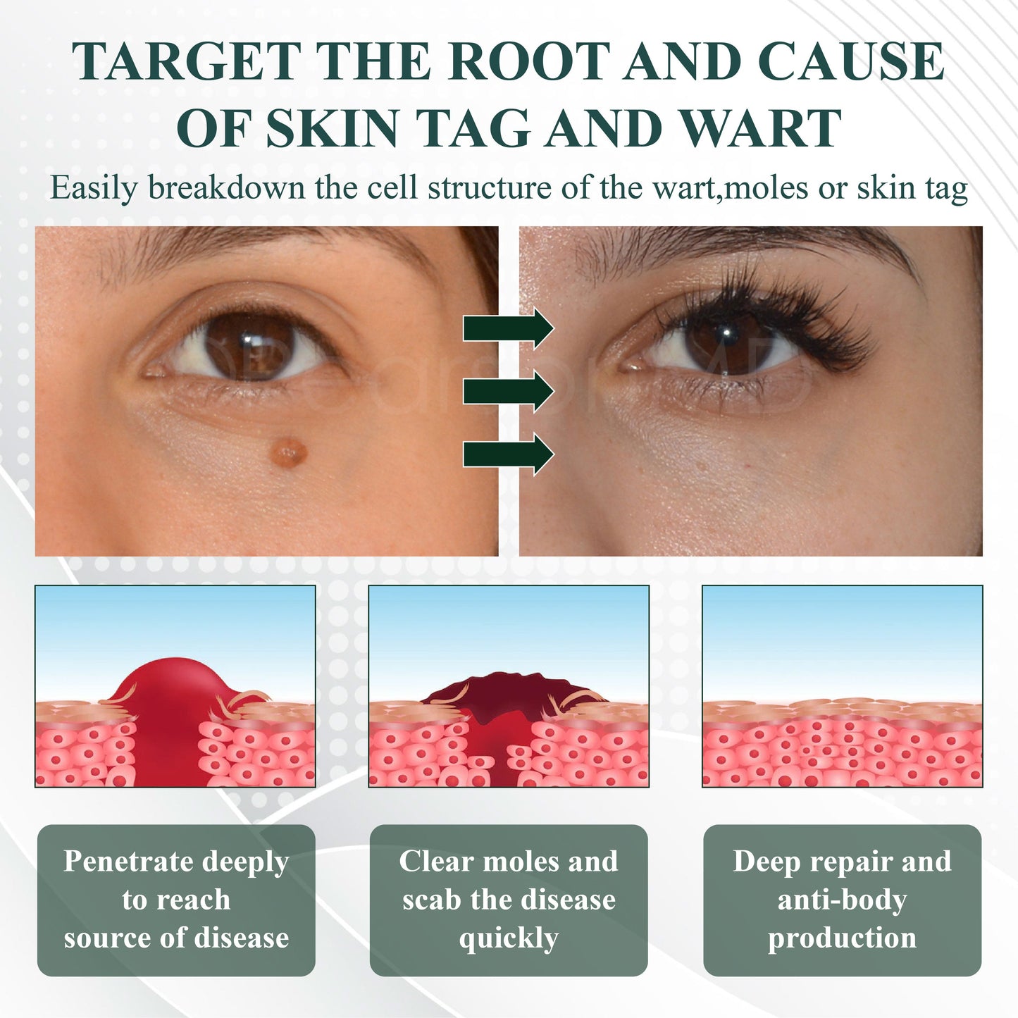 ATTDX® Tea Tree Focused WartAway MicroDart Patch